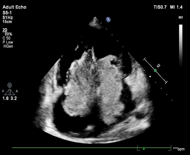 Bilateral atrial myxomas